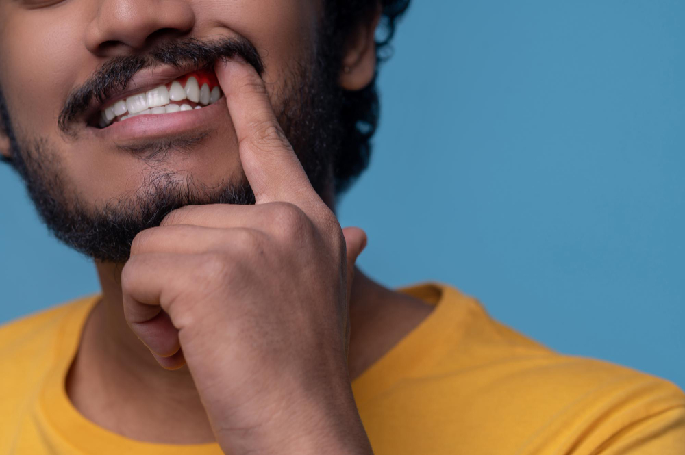 Gum Reshaping: Fixing a Gummy Smile