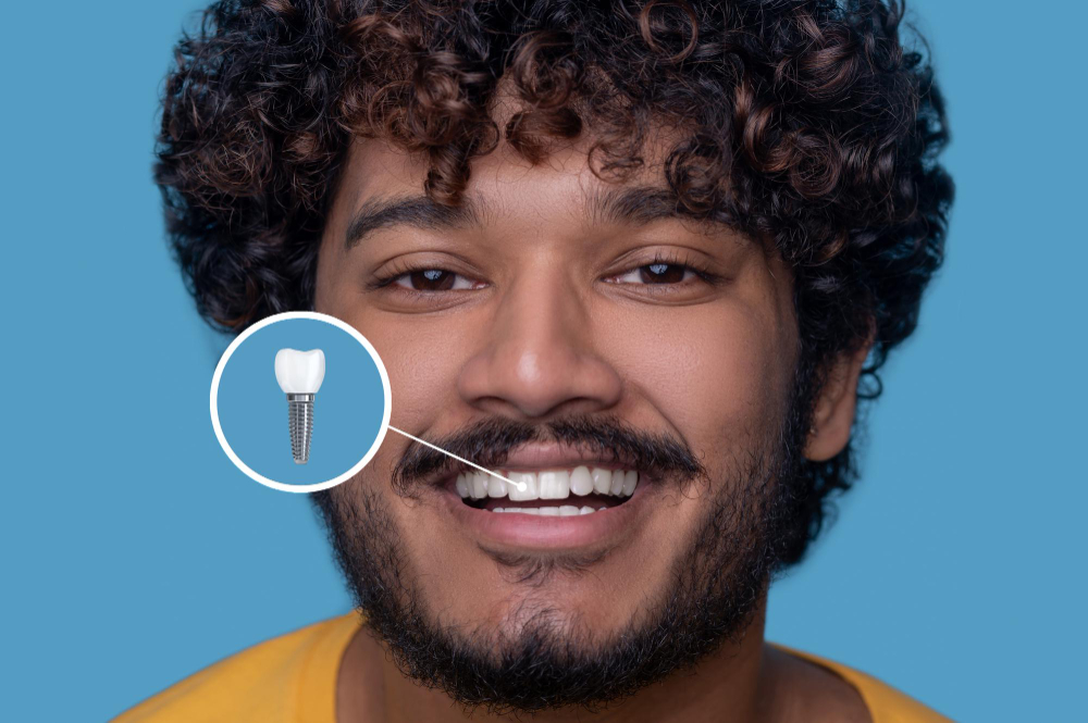 Dental Implants – Permanent Tooth Replacement | Roots Dental Care